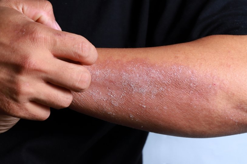 ayurvedic treatment for eczema