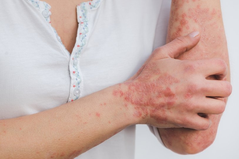 psoriasis ayurvedic psoriasis ayurvedic