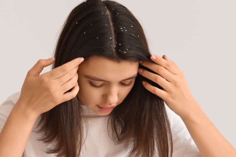 ayurvedic medicine for dandruff