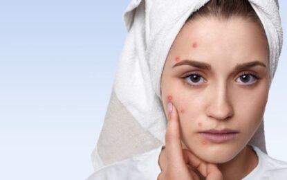ayurvedic acne treatment in dubai